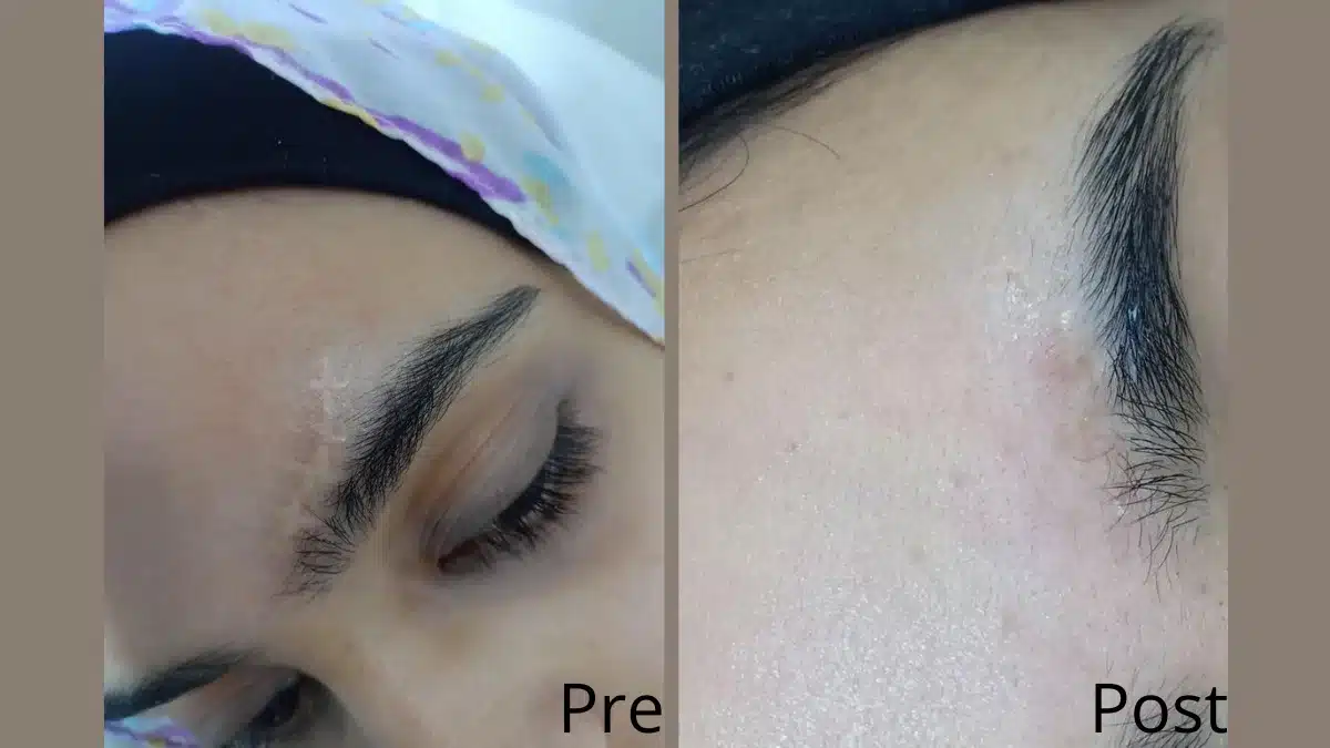 ازالة اثار الجروح بالليزر في الغردقة